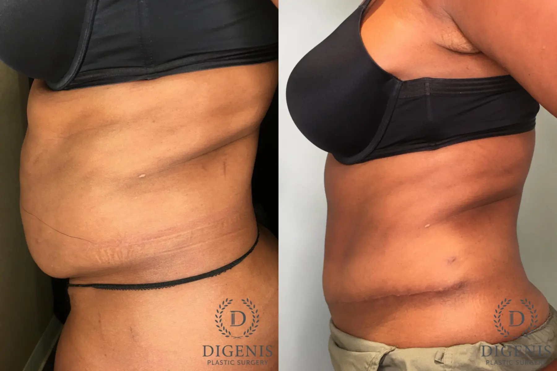 Tummy Tuck: Patient 24 - Before and After 5