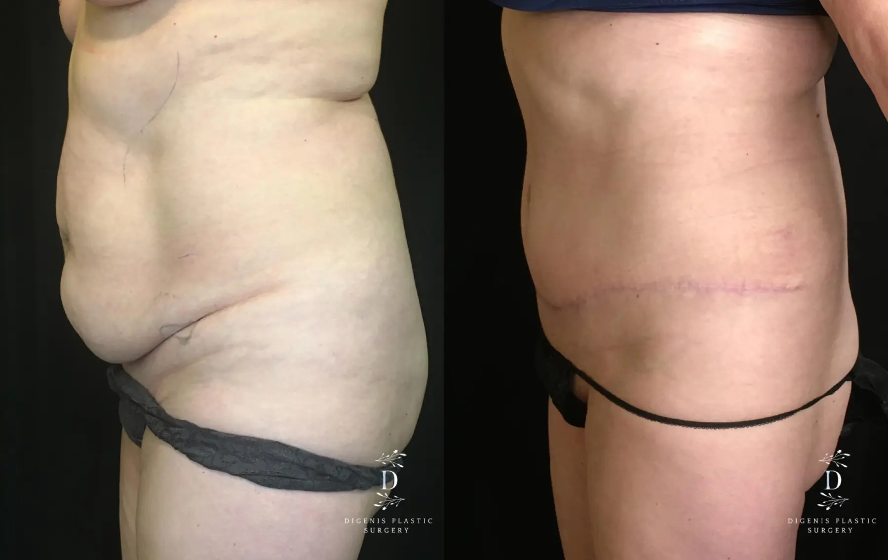 Tummy Tuck: Patient 19 - Before and After 5