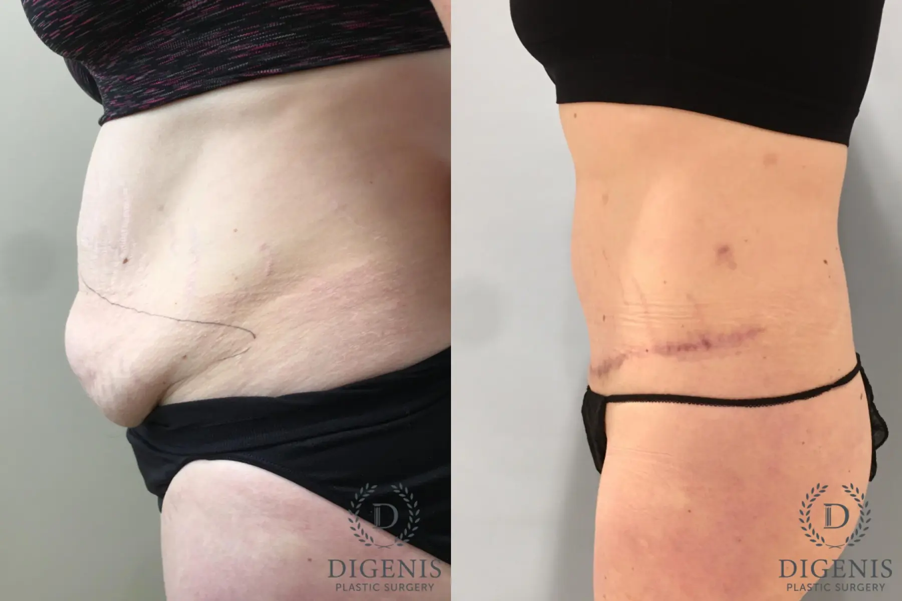 Tummy Tuck: Patient 30 - Before and After 5