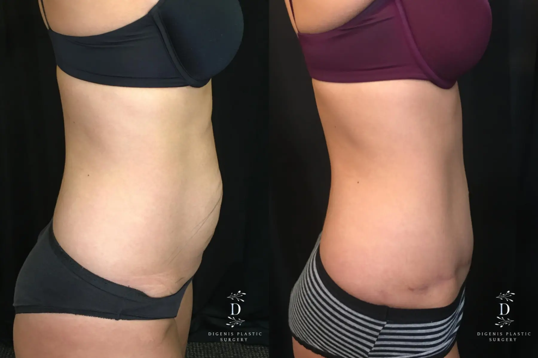 Tummy Tuck: Patient 15 - Before and After 3