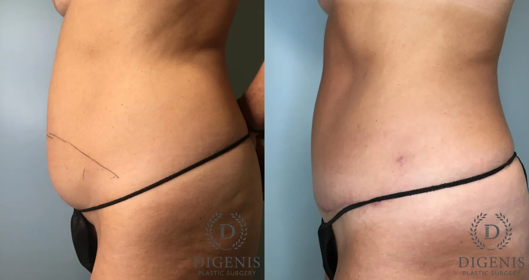 Tummy Tuck: Patient 2 - Before and After 2