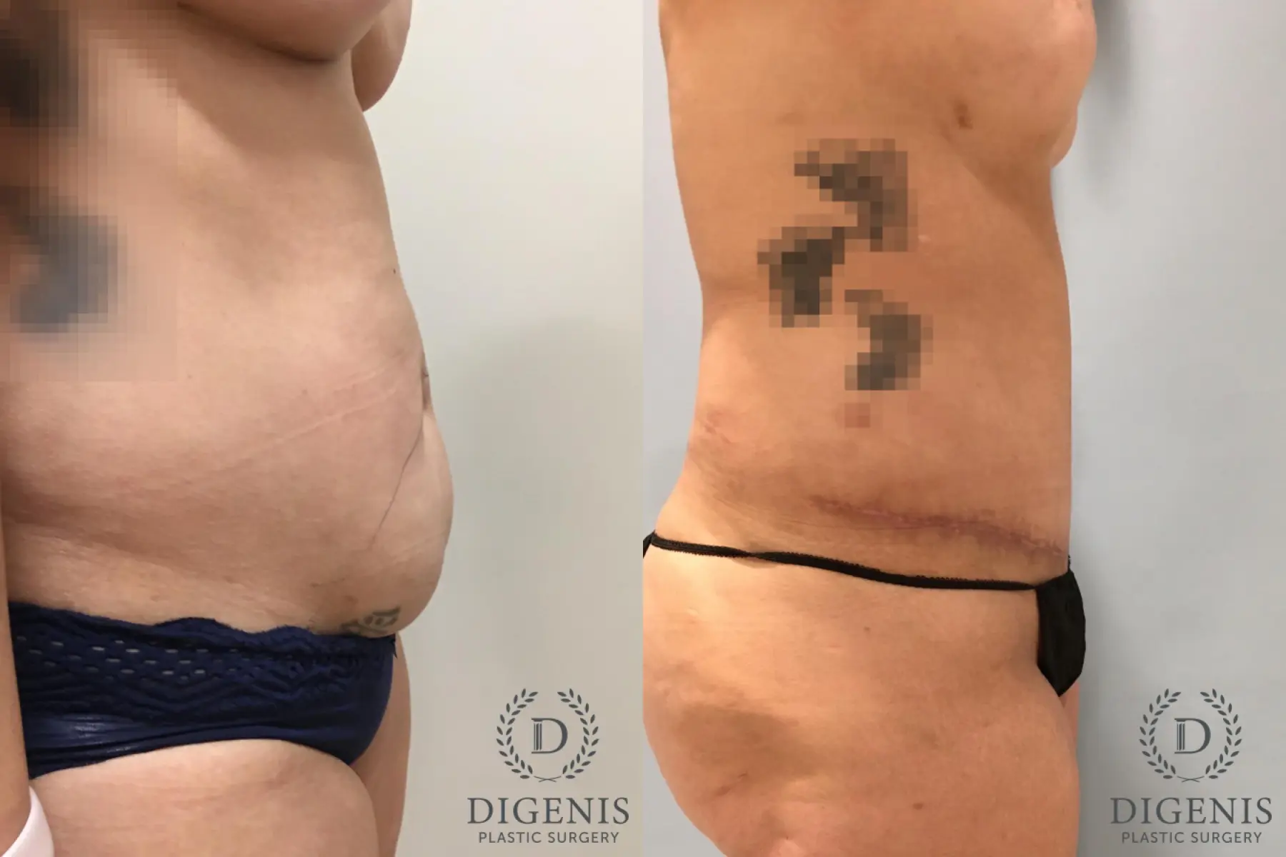 Tummy Tuck: Patient 26 - Before and After 3