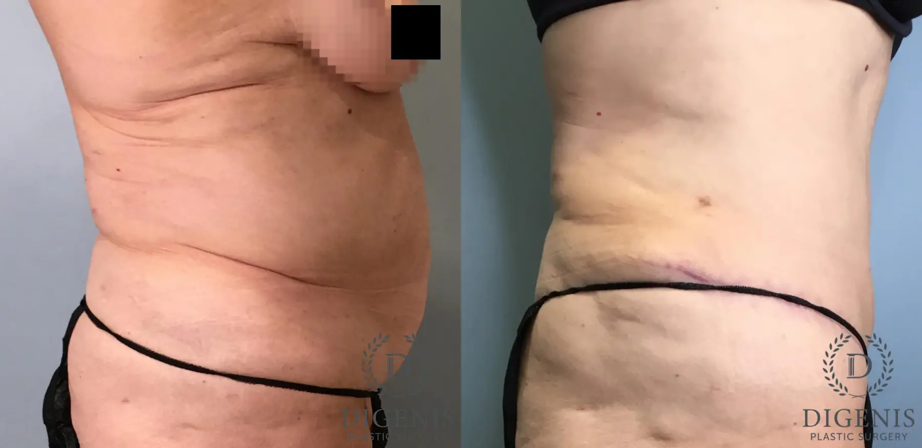 Tummy Tuck: Patient 34 - Before and After 3