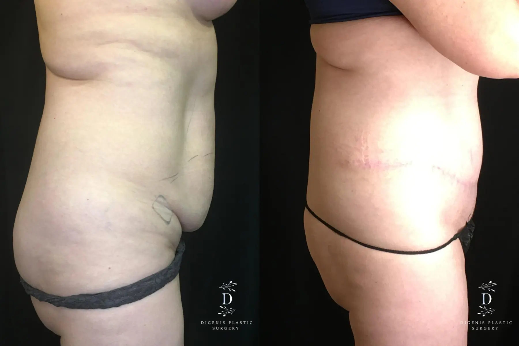 Tummy Tuck: Patient 19 - Before and After 3