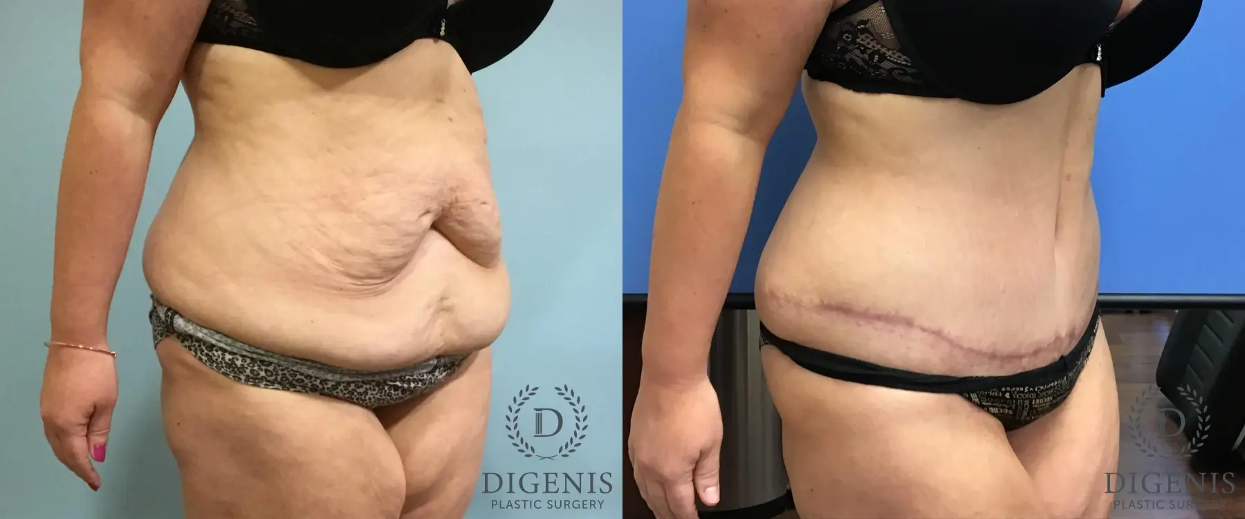 Tummy Tuck: Patient 11 - Before and After 2