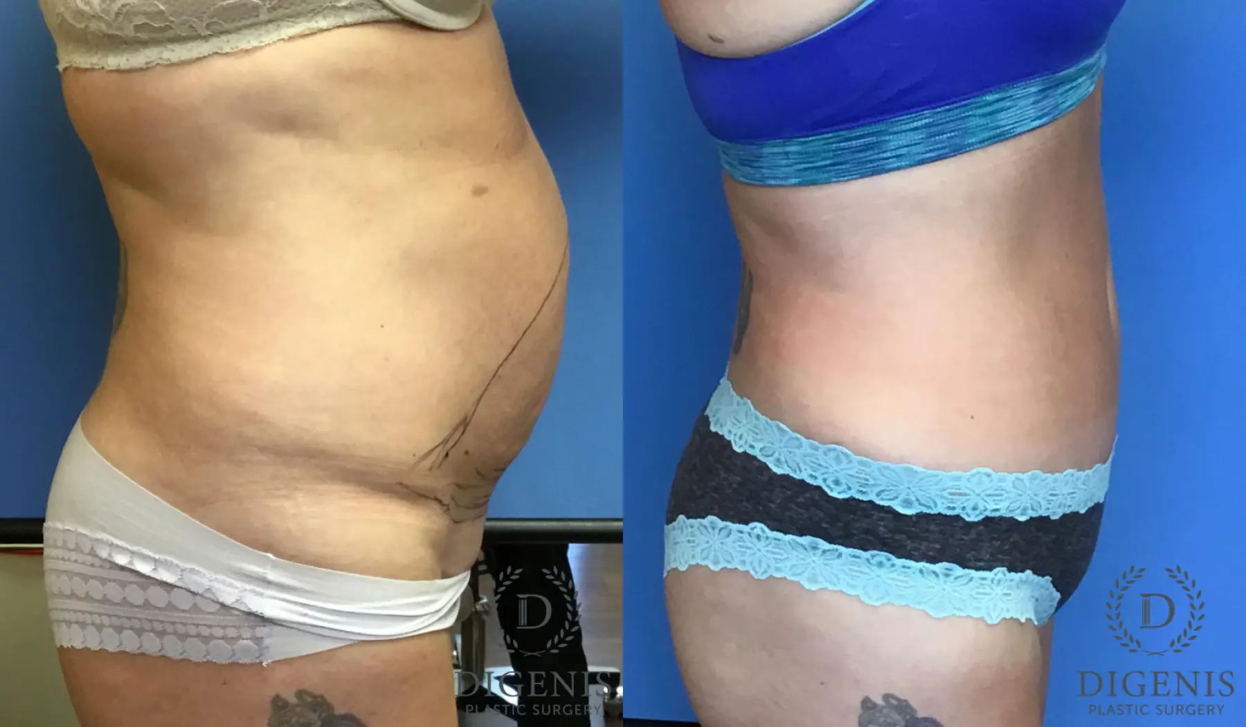 Tummy Tuck: Patient 8 - Before and After 3