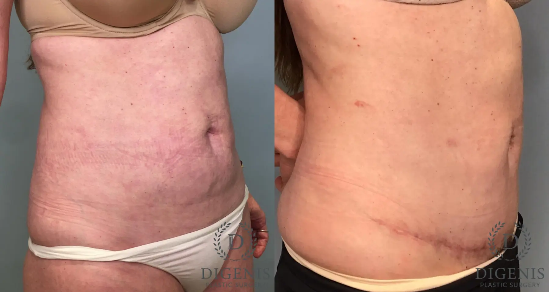 Tummy Tuck: Patient 6 - Before and After 5