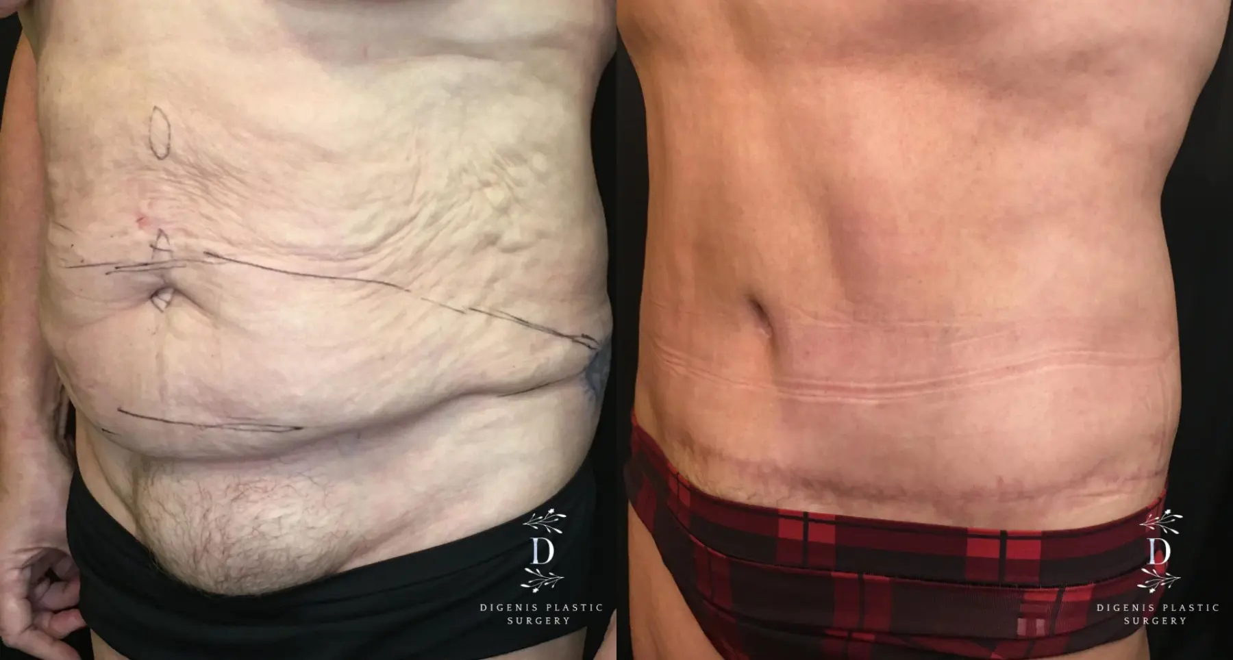 Tummy Tuck: Patient 16 - Before and After 4