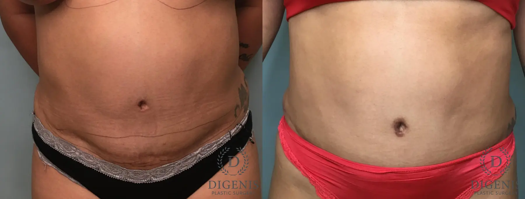 Tummy Tuck: Patient 35 - Before and After 1