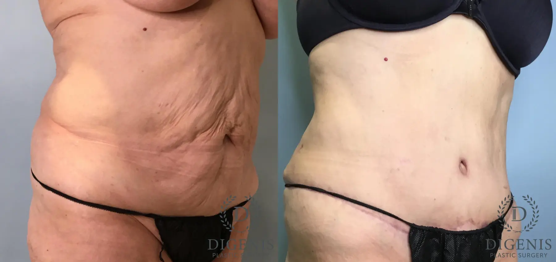 Tummy Tuck: Patient 34 - Before and After 2