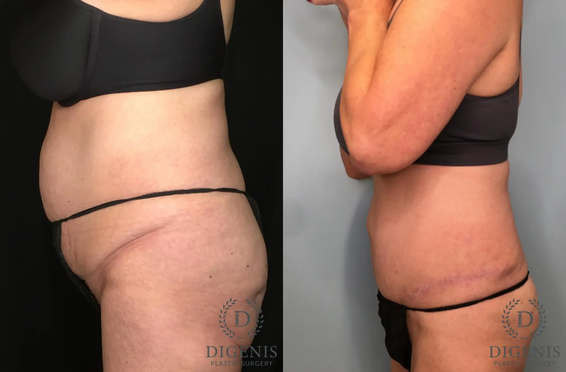 Tummy Tuck: Patient 28 - Before and After 3