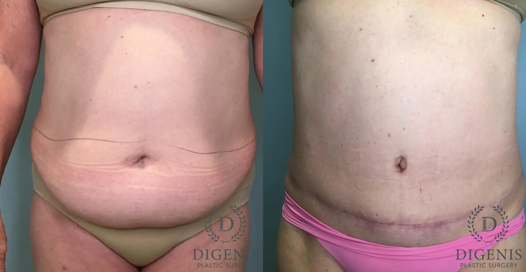 Tummy Tuck: Patient 29 - Before and After  