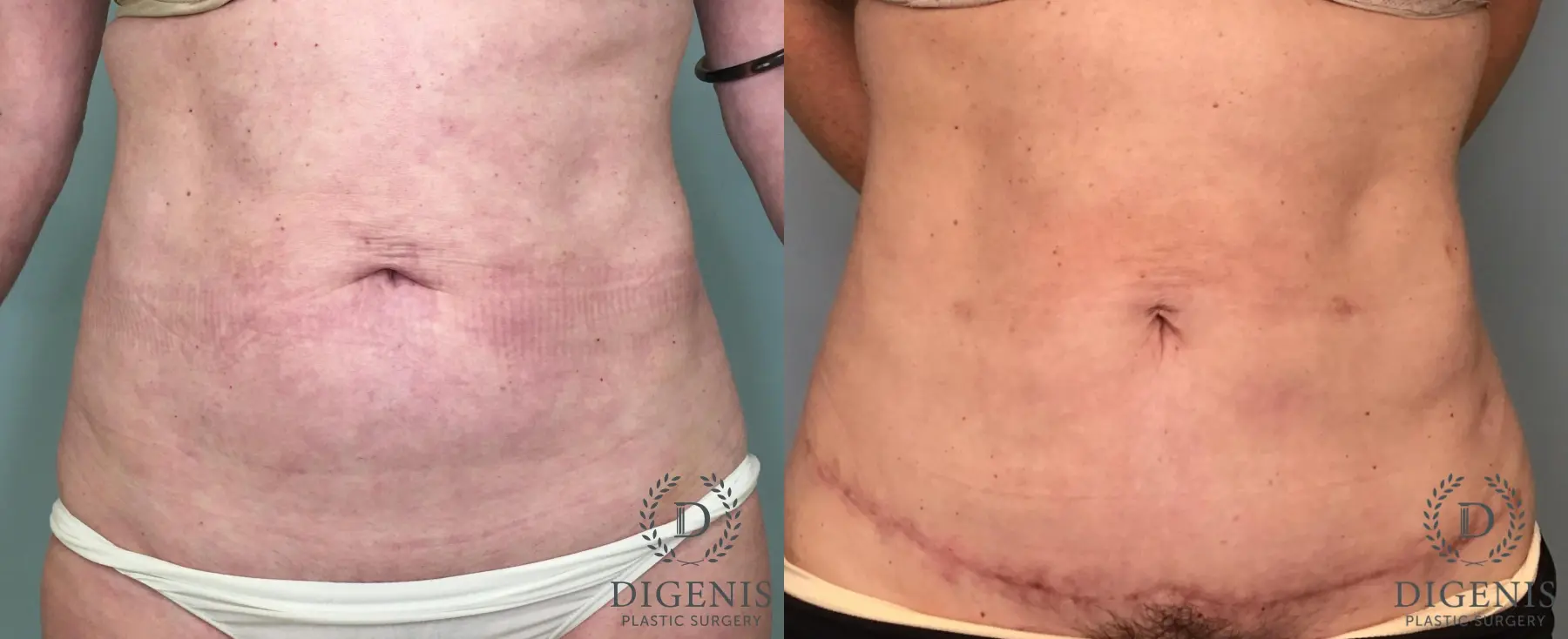 Tummy Tuck: Patient 6 - Before and After  