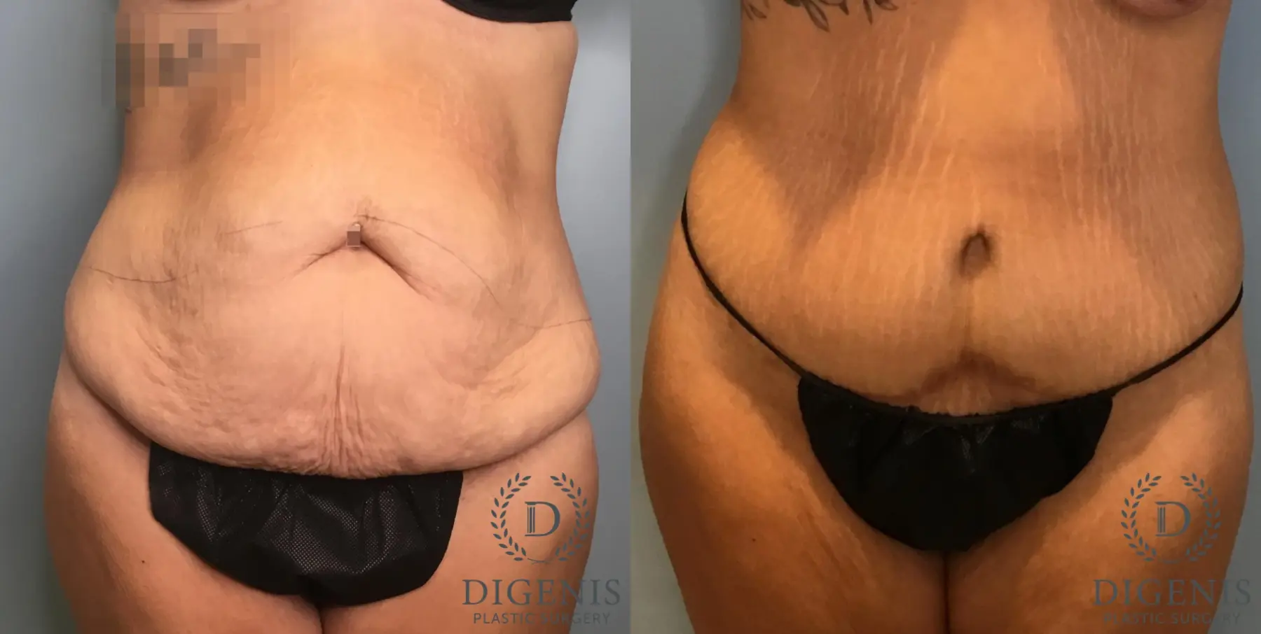 Tummy Tuck: Patient 23 - Before and After  