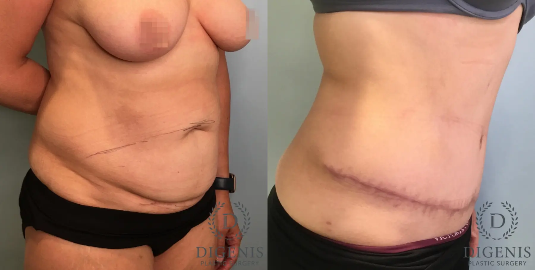 Tummy Tuck: Patient 31 - Before and After 2