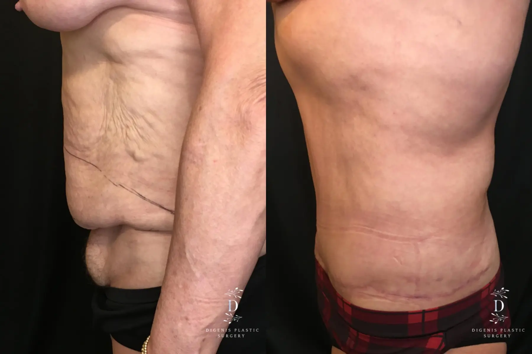Tummy Tuck: Patient 16 - Before and After 5