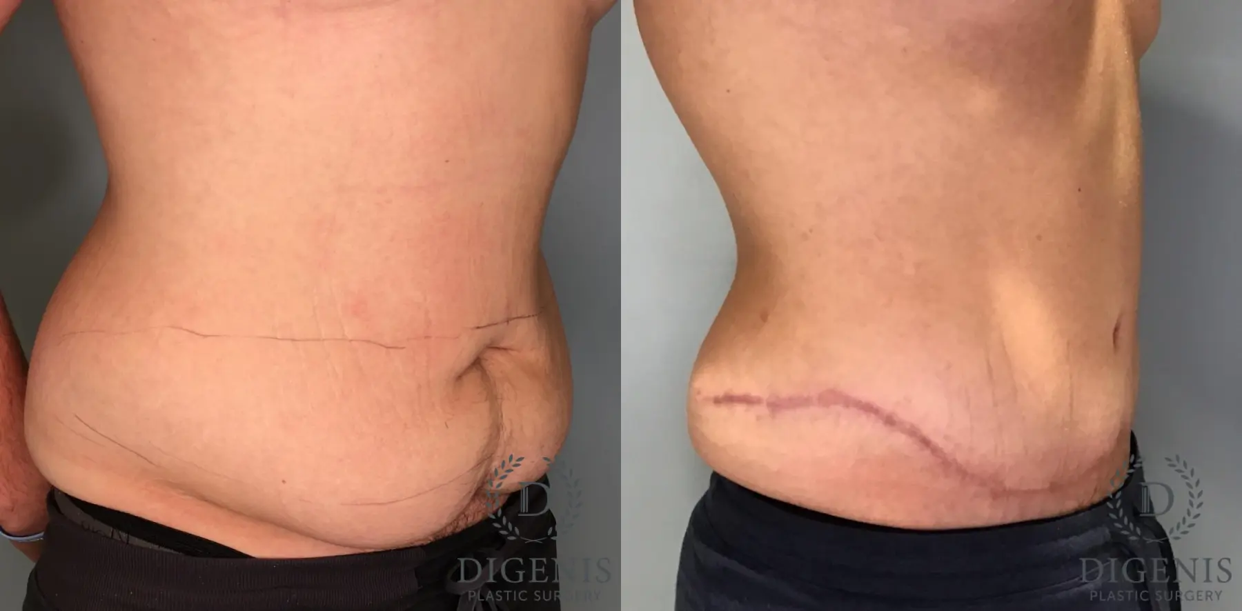 Tummy Tuck: Patient 36 - Before and After 2