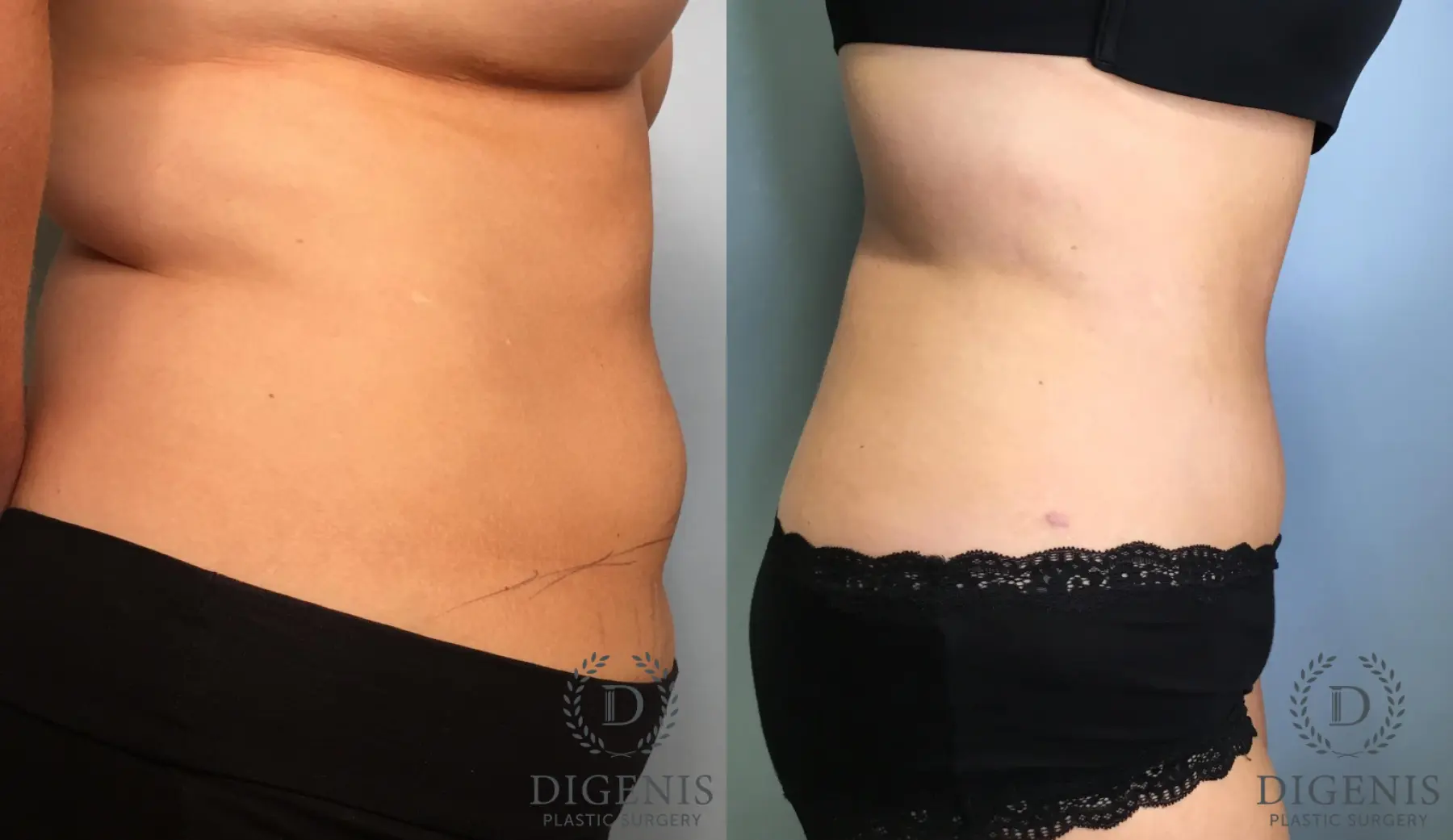 Tummy Tuck: Patient 33 - Before and After 3