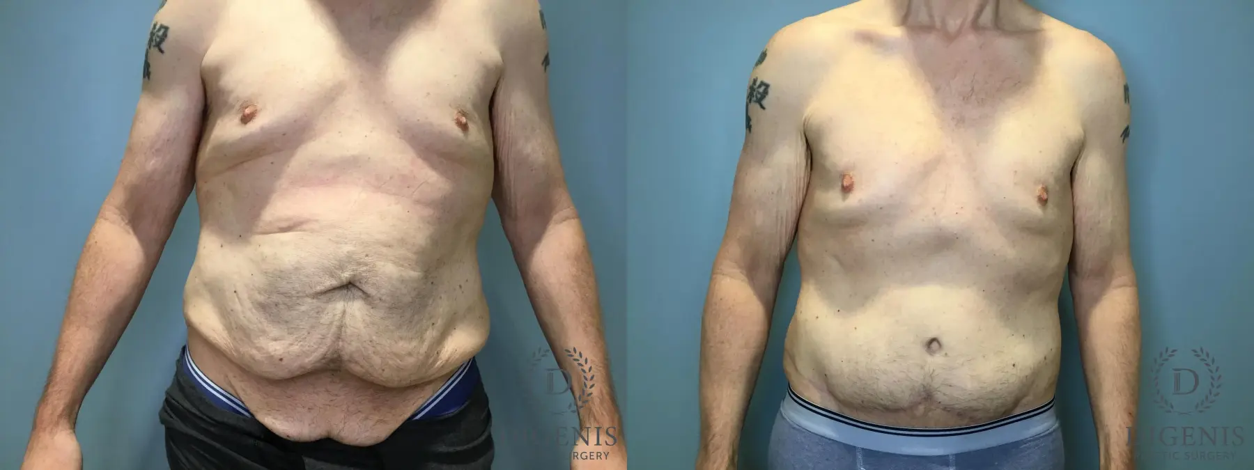 Tummy Tuck: Patient 5 - Before and After  