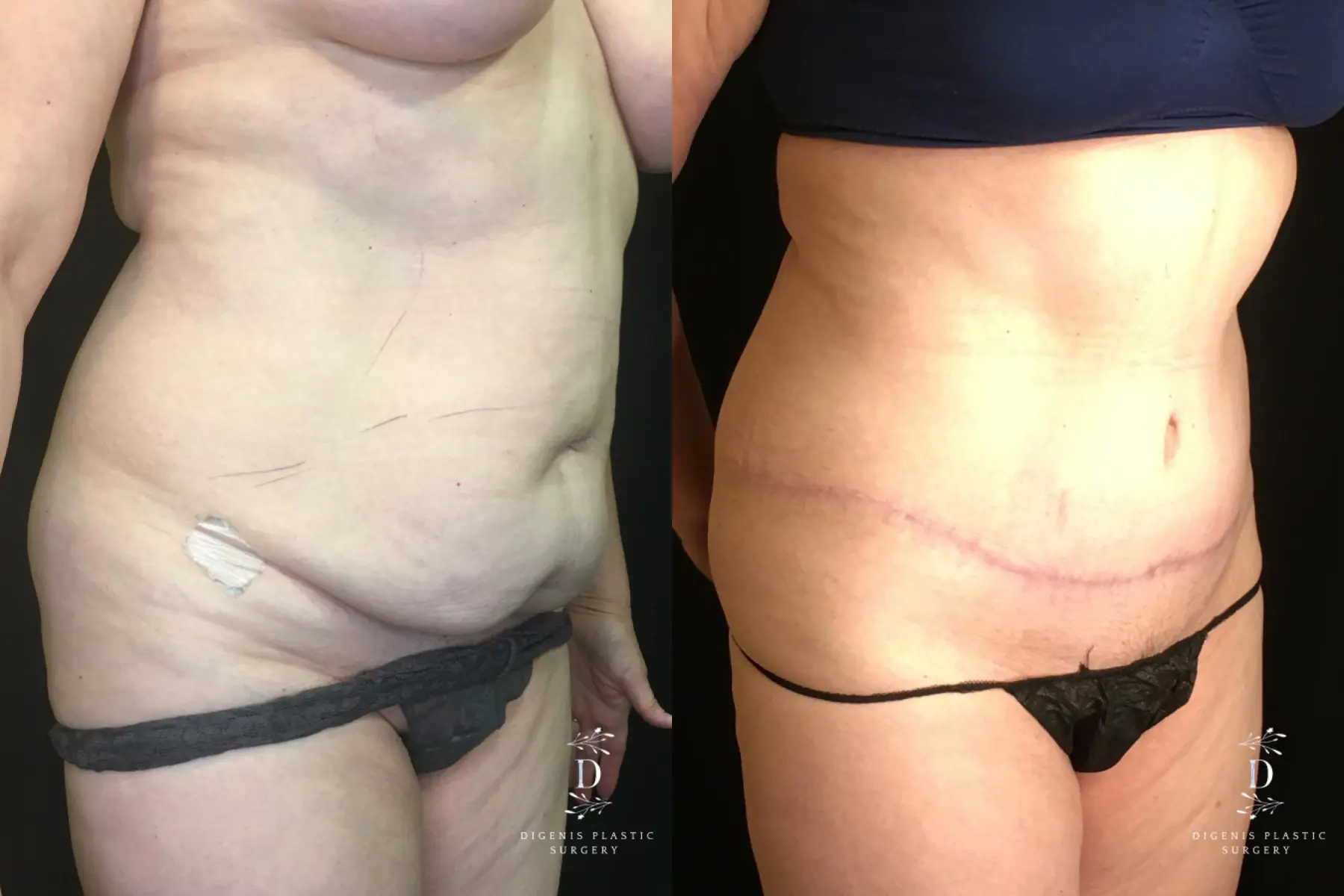 Tummy Tuck: Patient 19 - Before and After 2