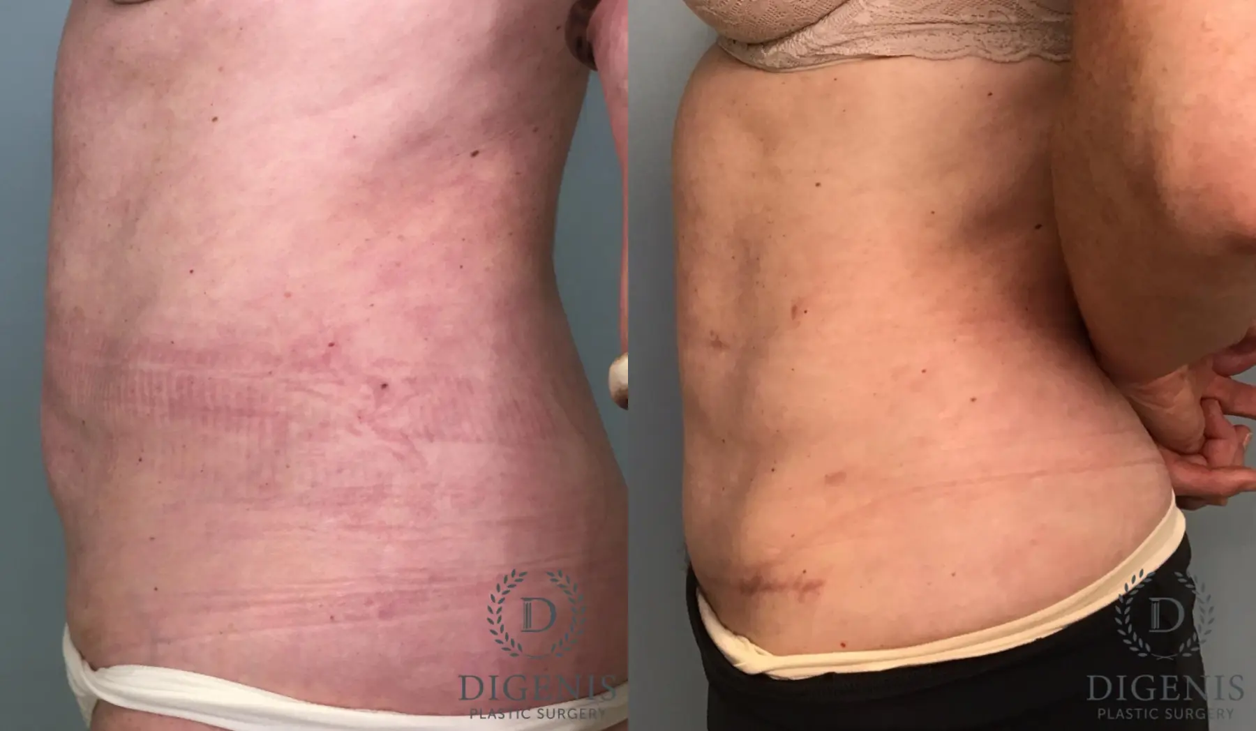 Tummy Tuck: Patient 6 - Before and After 3