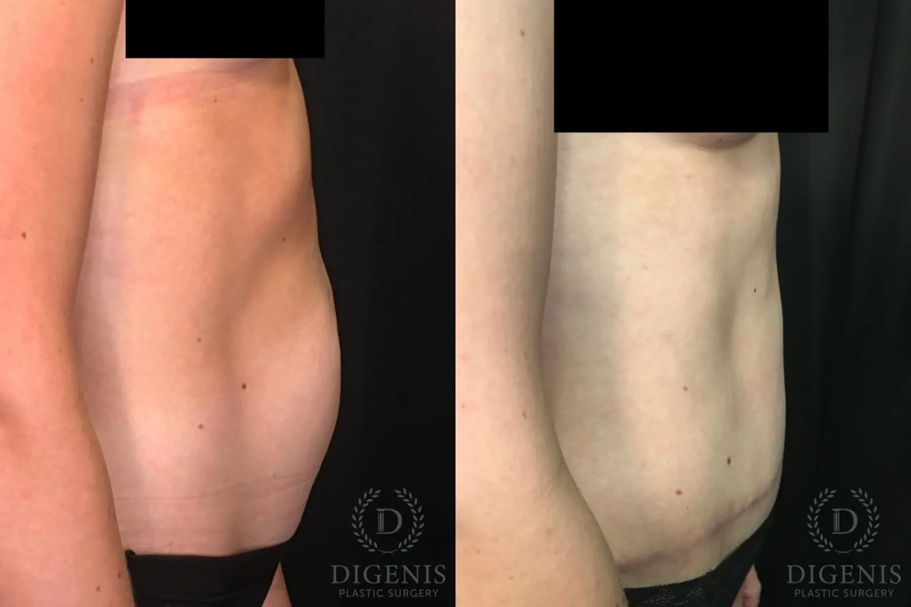 Tummy Tuck: Patient 3 - Before and After 3