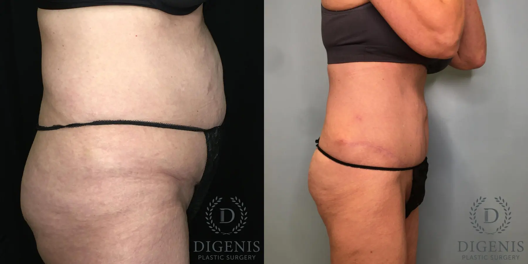 Tummy Tuck: Patient 28 - Before and After 5