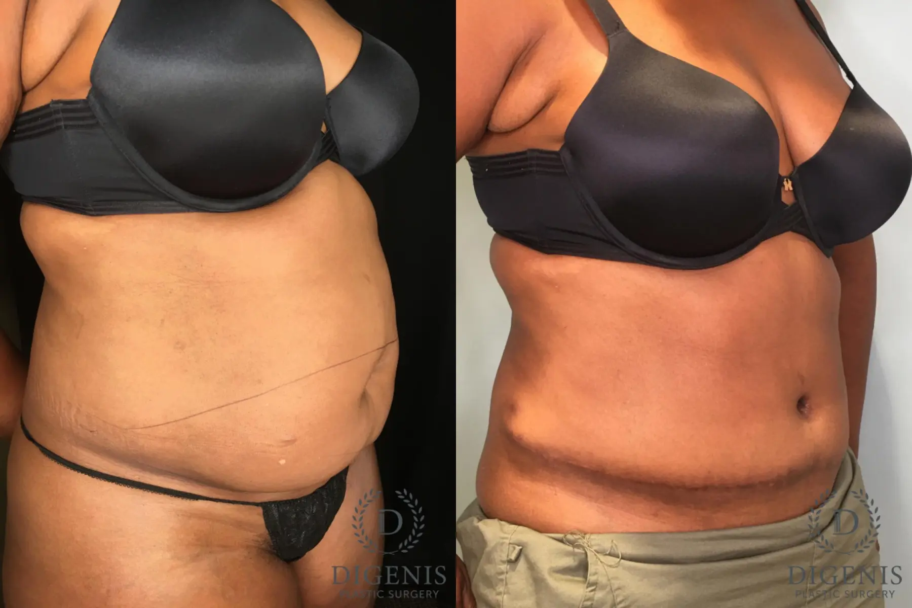 Tummy Tuck: Patient 24 - Before and After 2
