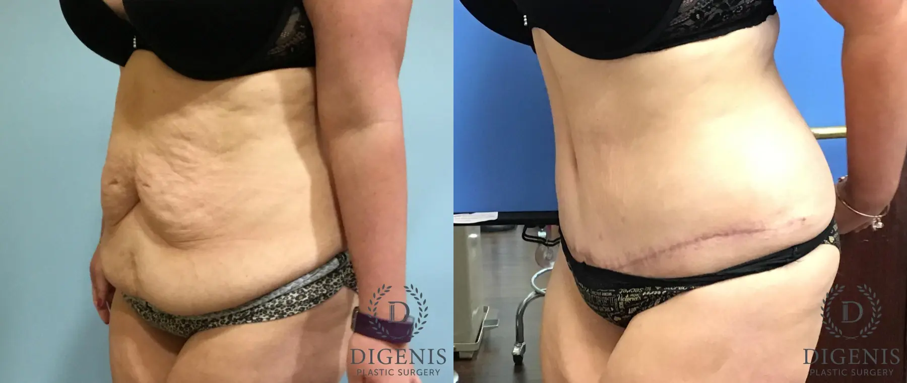 Tummy Tuck: Patient 11 - Before and After 4