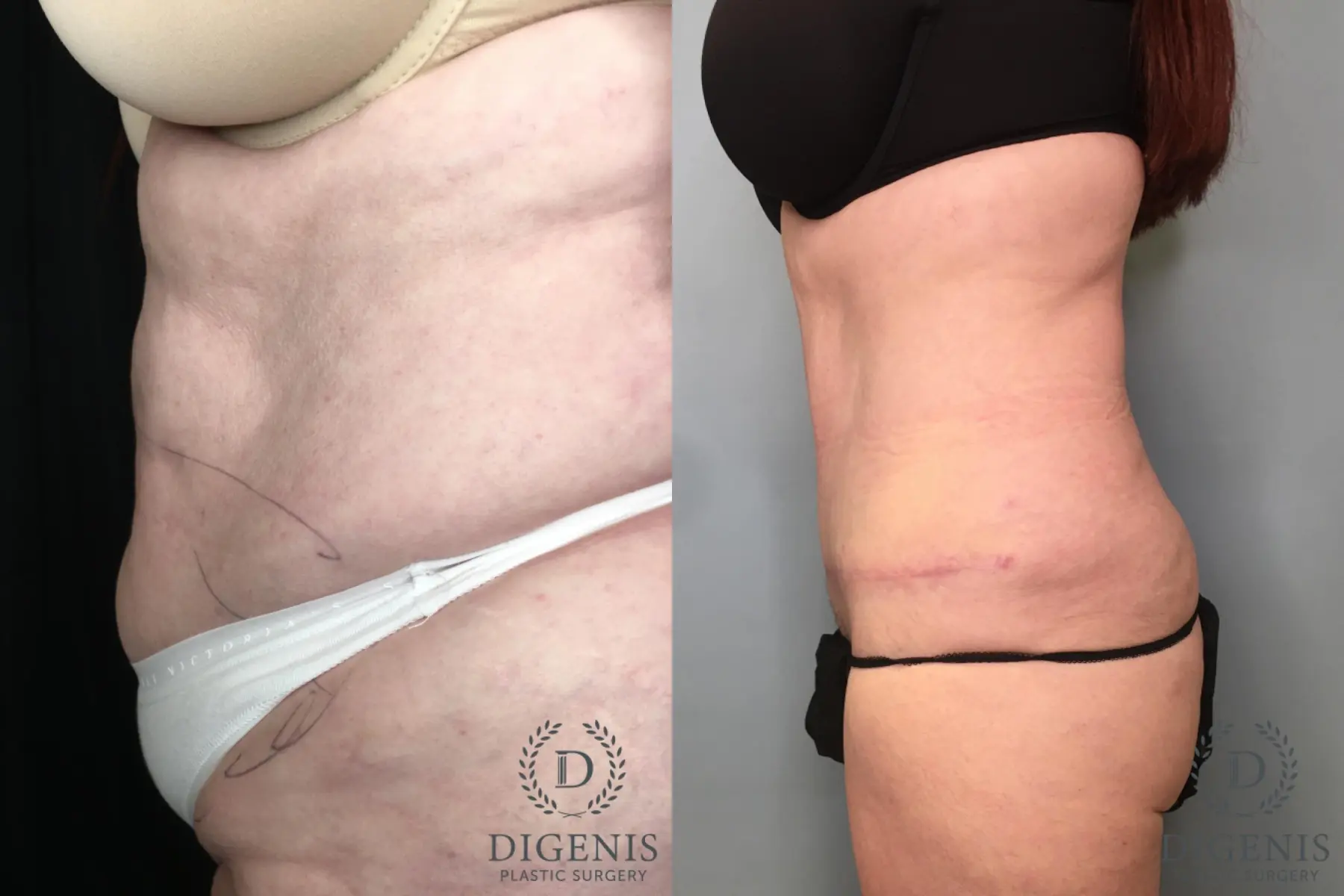 Tummy Tuck: Patient 25 - Before and After 3
