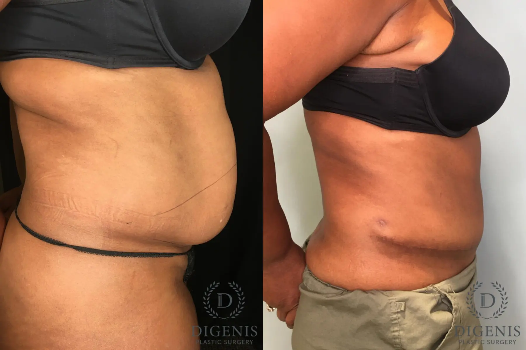 Tummy Tuck: Patient 13 - Before and After 5