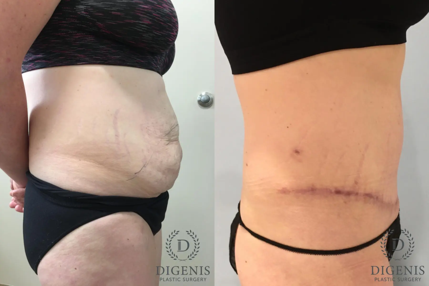 Tummy Tuck: Patient 30 - Before and After 3