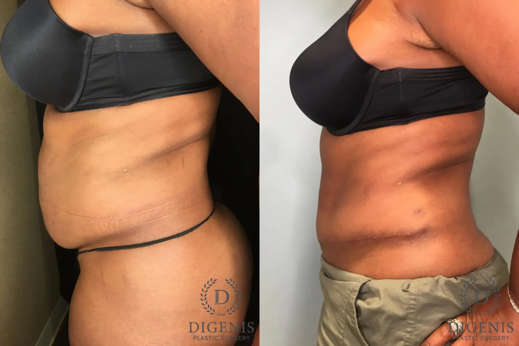 Tummy Tuck: Patient 13 - Before and After 3