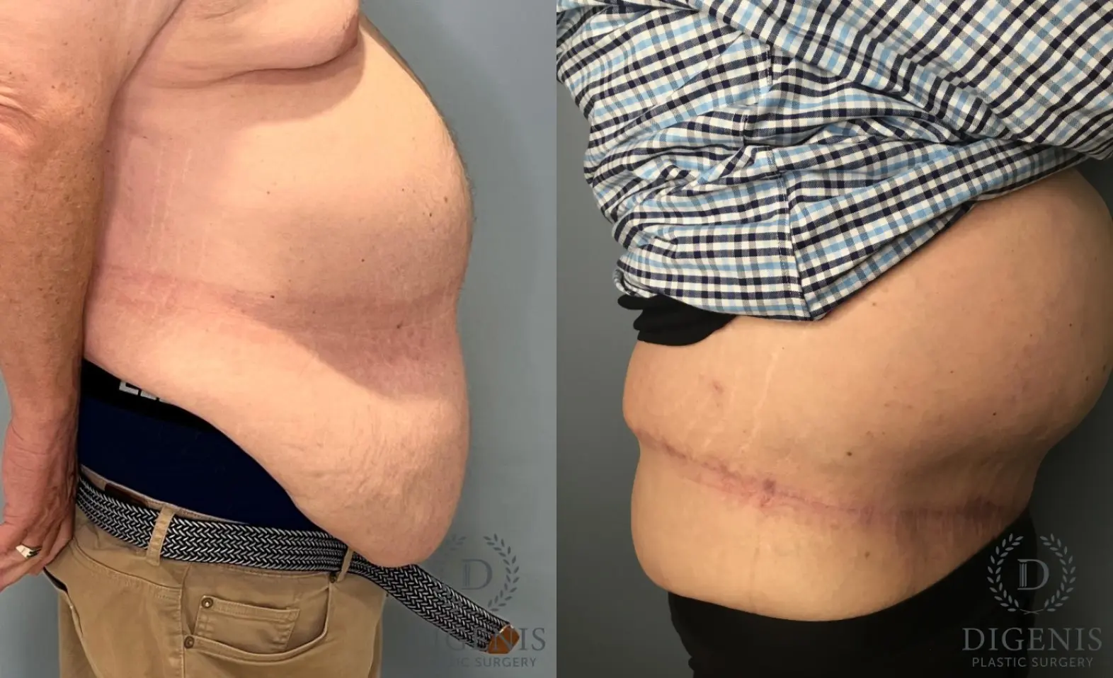 Tummy Tuck: Patient 4 - Before and After 2
