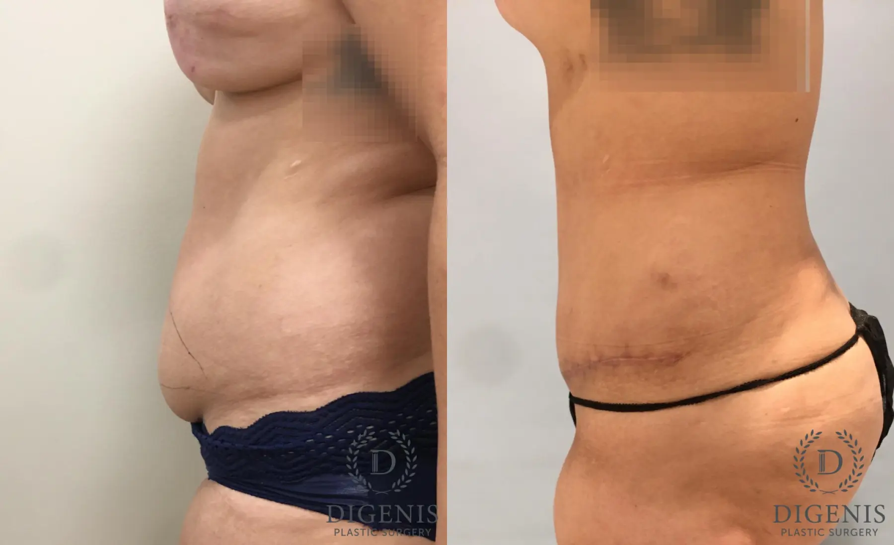 Tummy Tuck: Patient 26 - Before and After 5