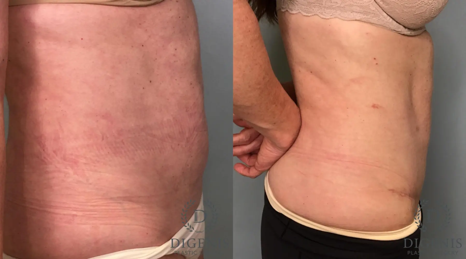 Tummy Tuck: Patient 6 - Before and After 4