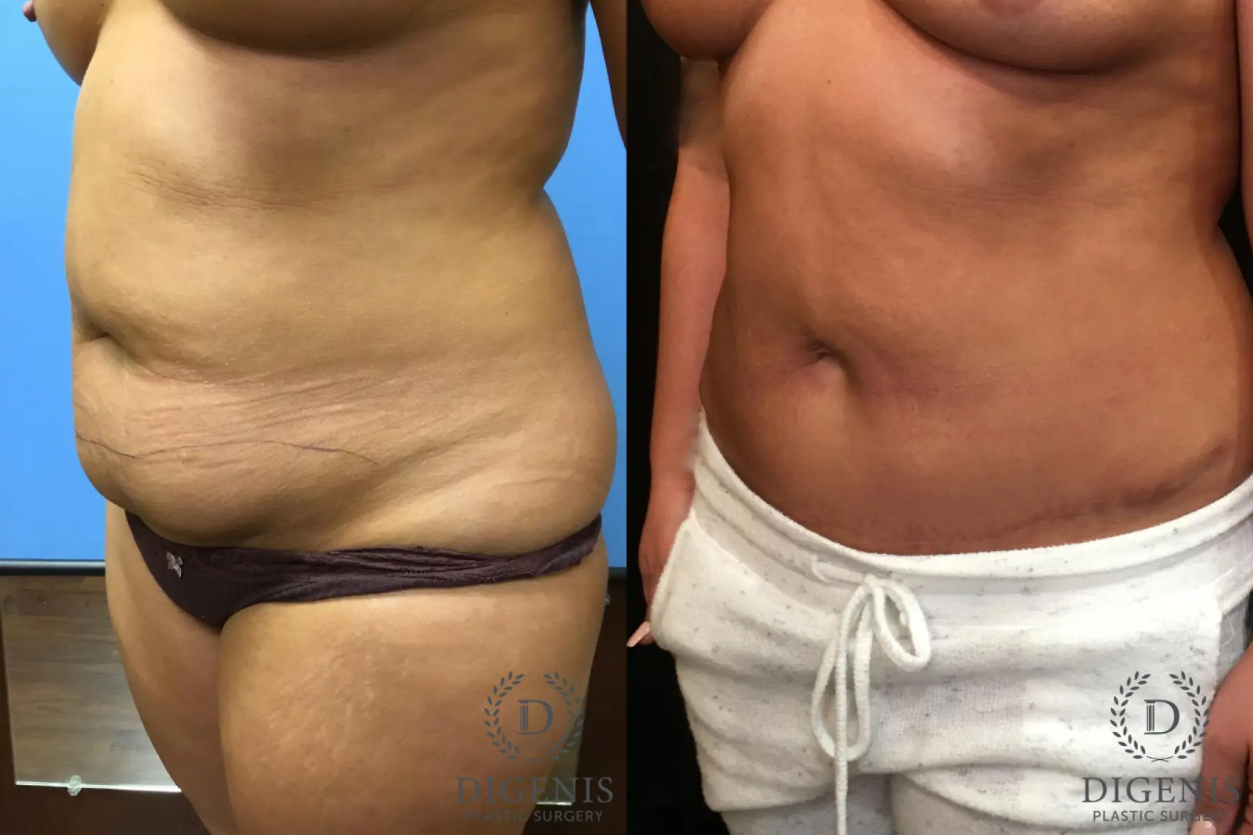 Tummy Tuck: Patient 7 - Before and After 4