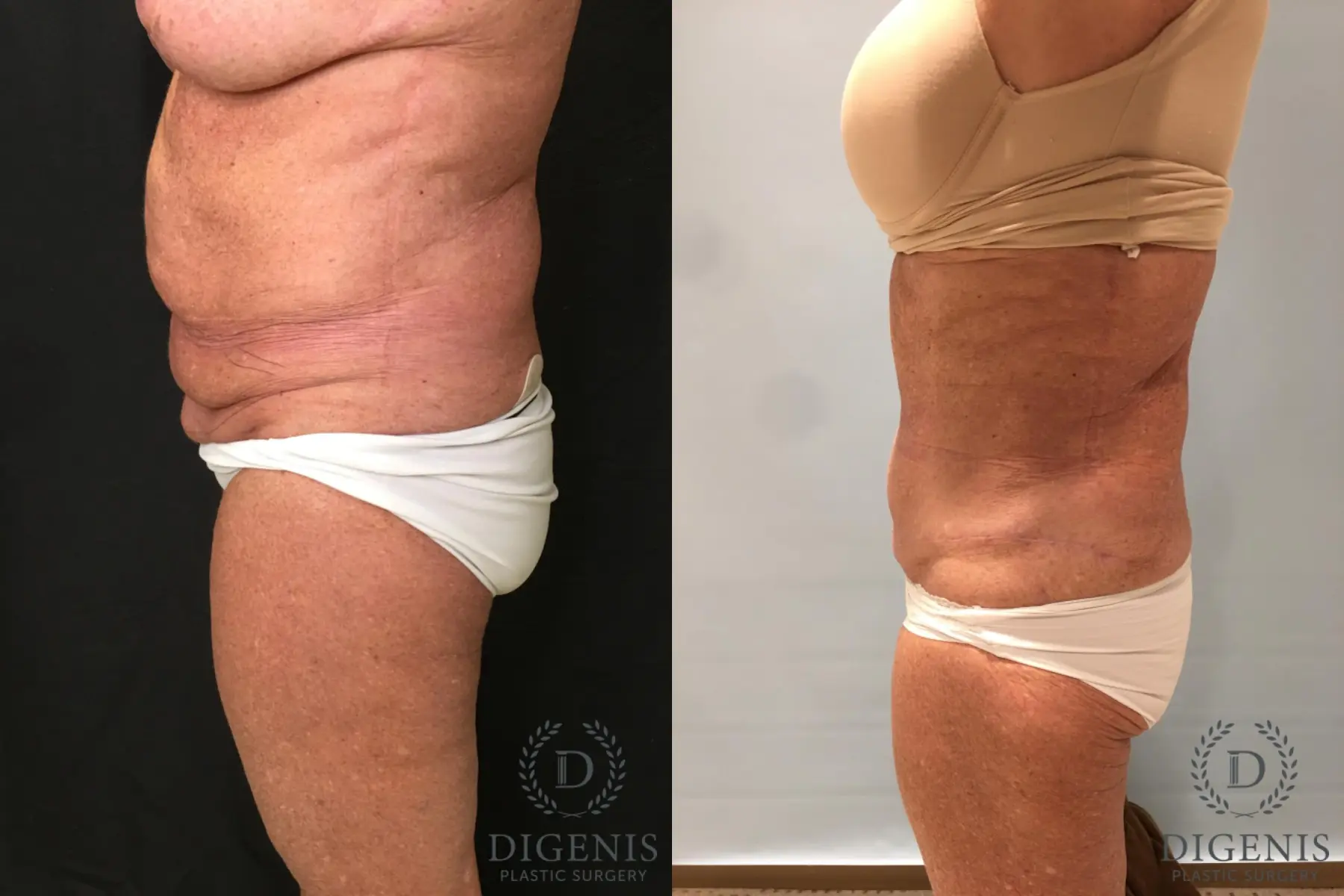 Tummy Tuck: Patient 27 - Before and After 3