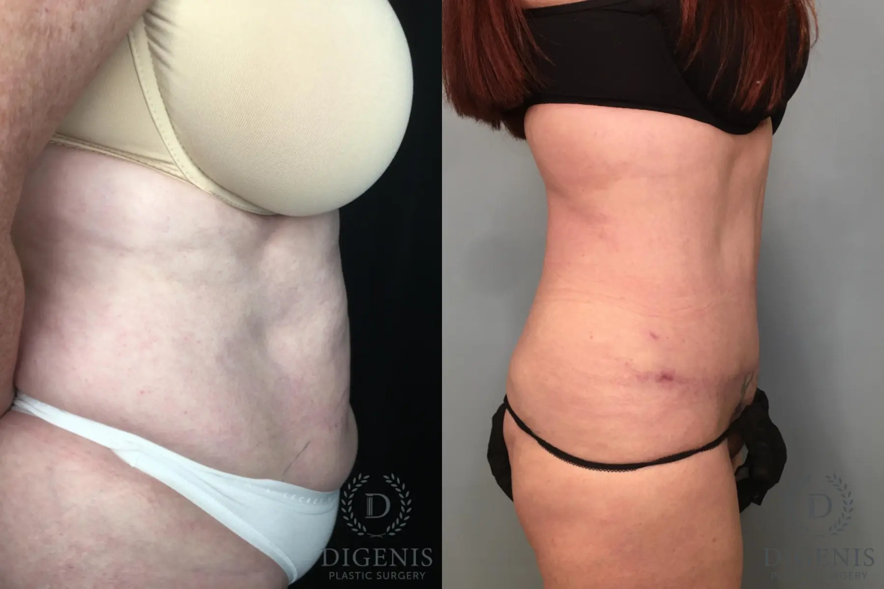 Tummy Tuck: Patient 25 - Before and After 4