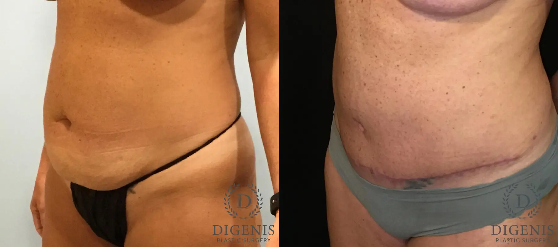Tummy Tuck: Patient 9 - Before and After 4