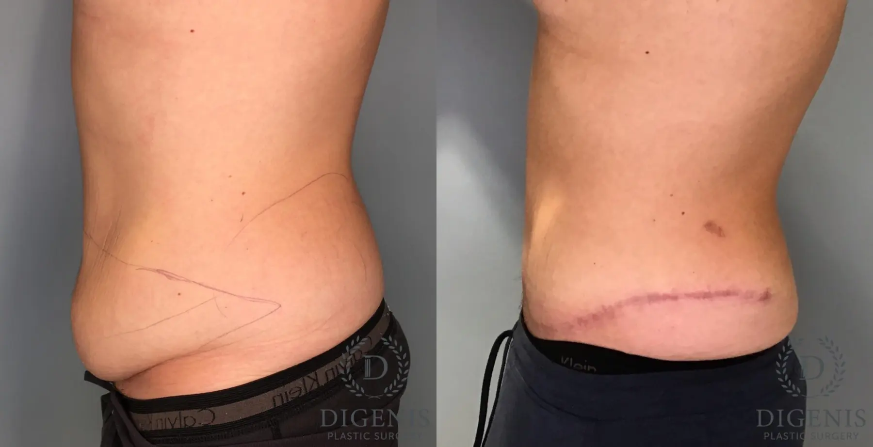 Tummy Tuck: Patient 36 - Before and After 5