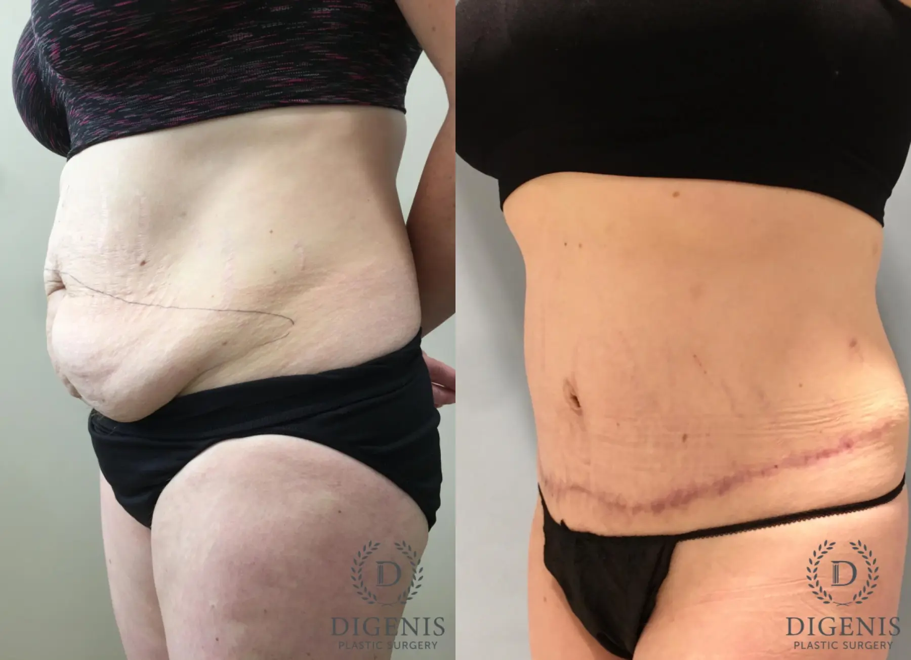 Tummy Tuck: Patient 30 - Before and After 4