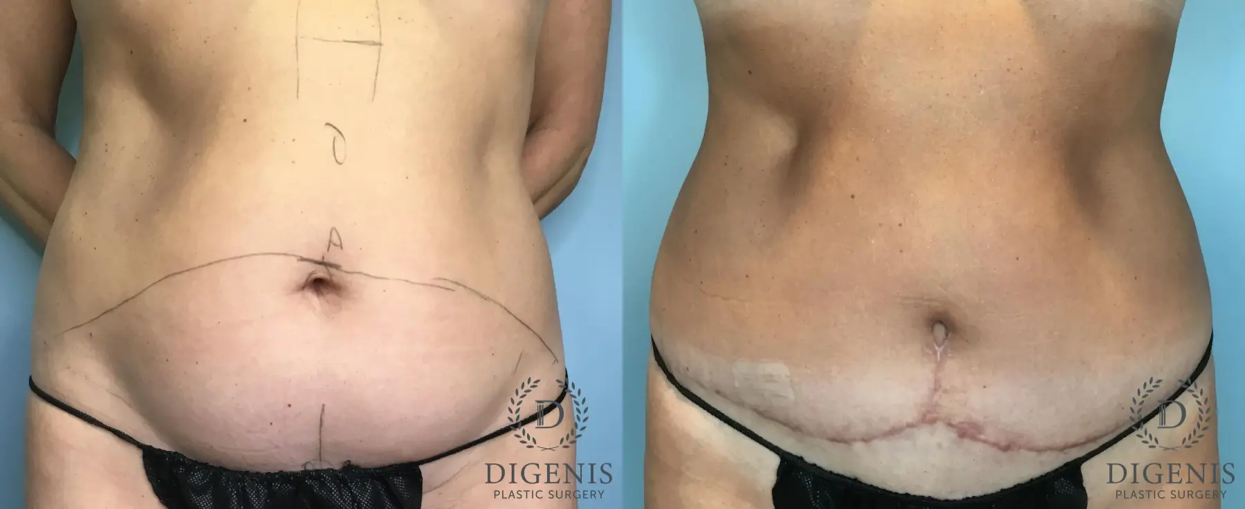 Tummy Tuck: Patient 2 - Before and After  