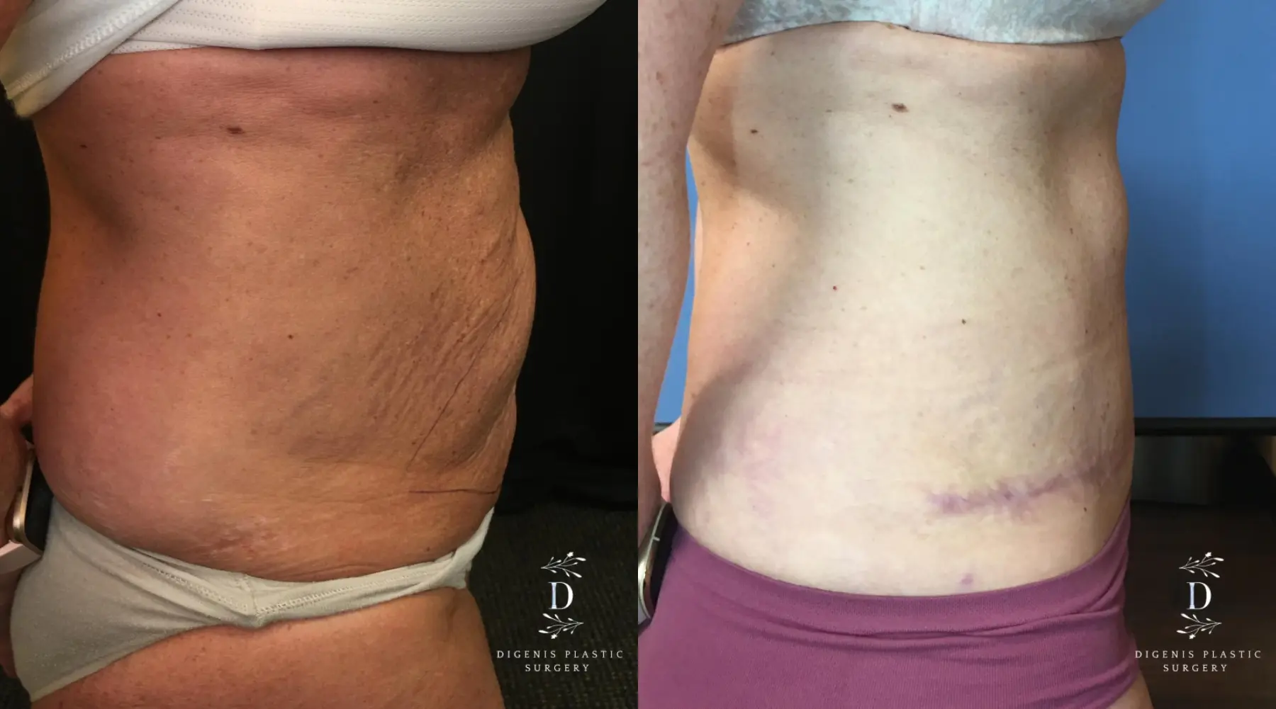 Tummy Tuck: Patient 17 - Before and After 3