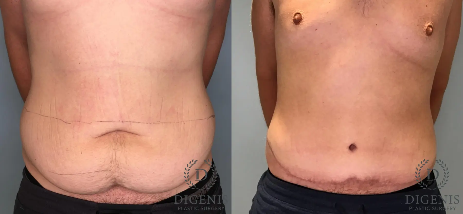 Tummy Tuck: Patient 36 - Before and After 1