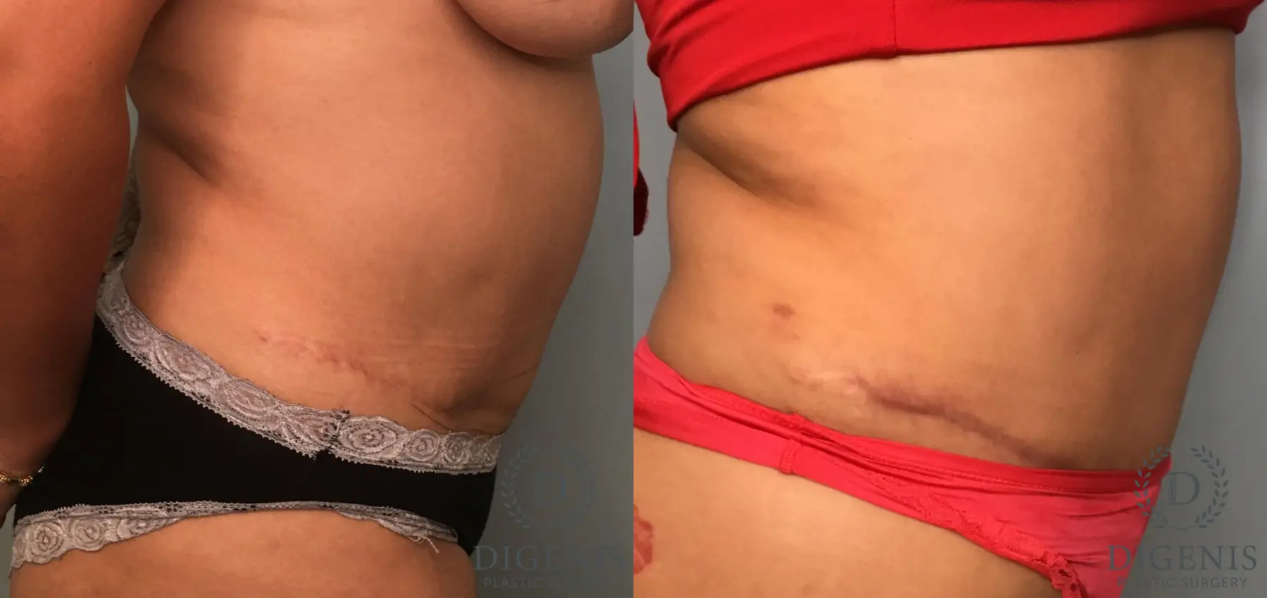 Tummy Tuck: Patient 35 - Before and After 3