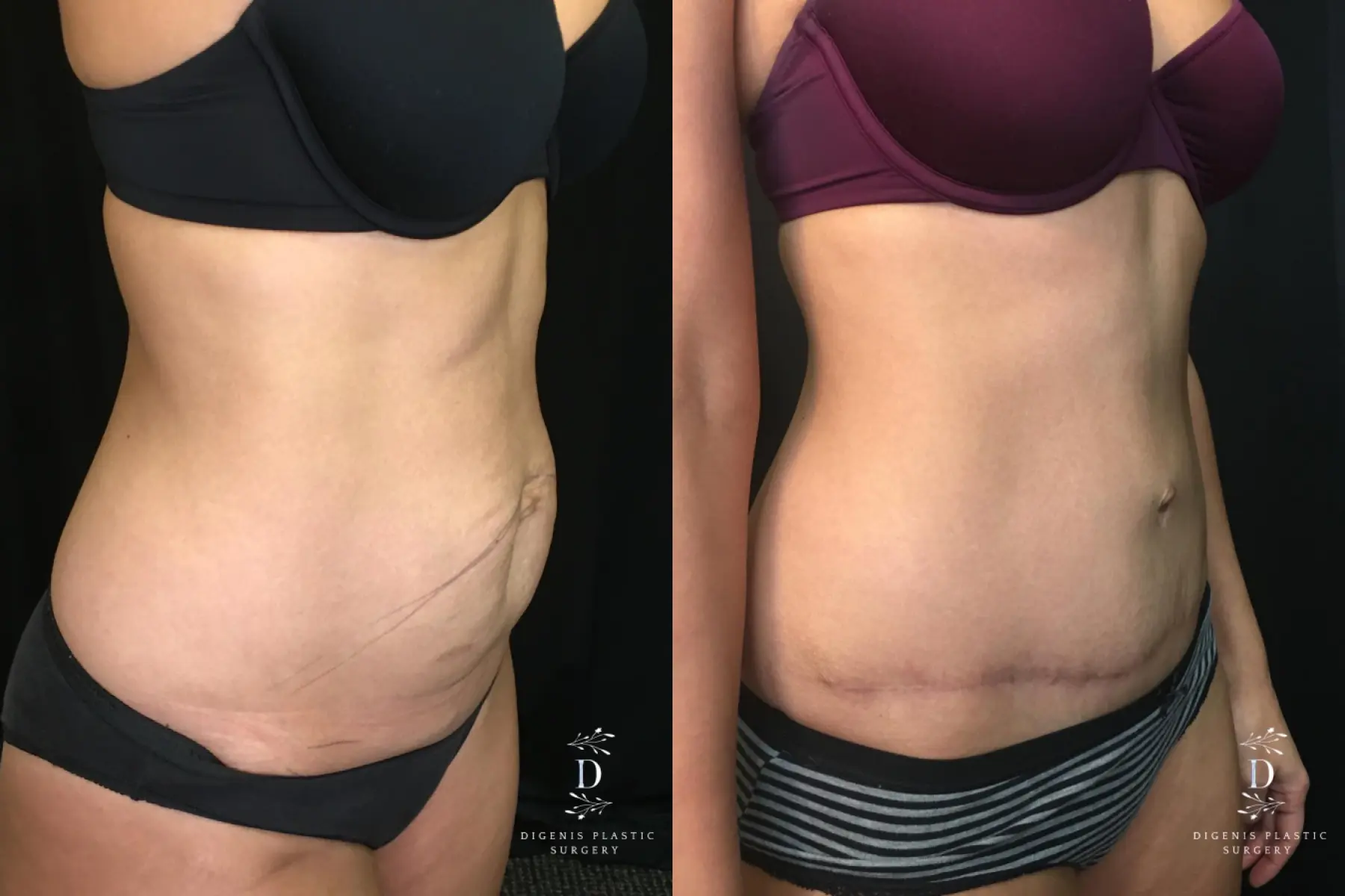 Tummy Tuck: Patient 15 - Before and After 2