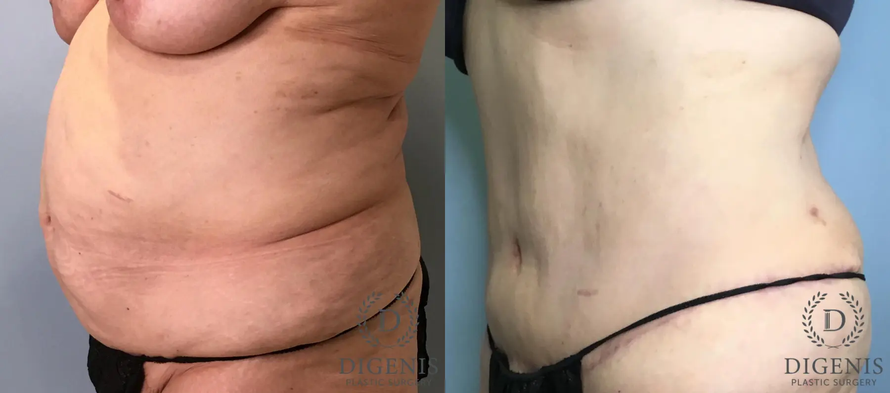 Tummy Tuck: Patient 34 - Before and After 4