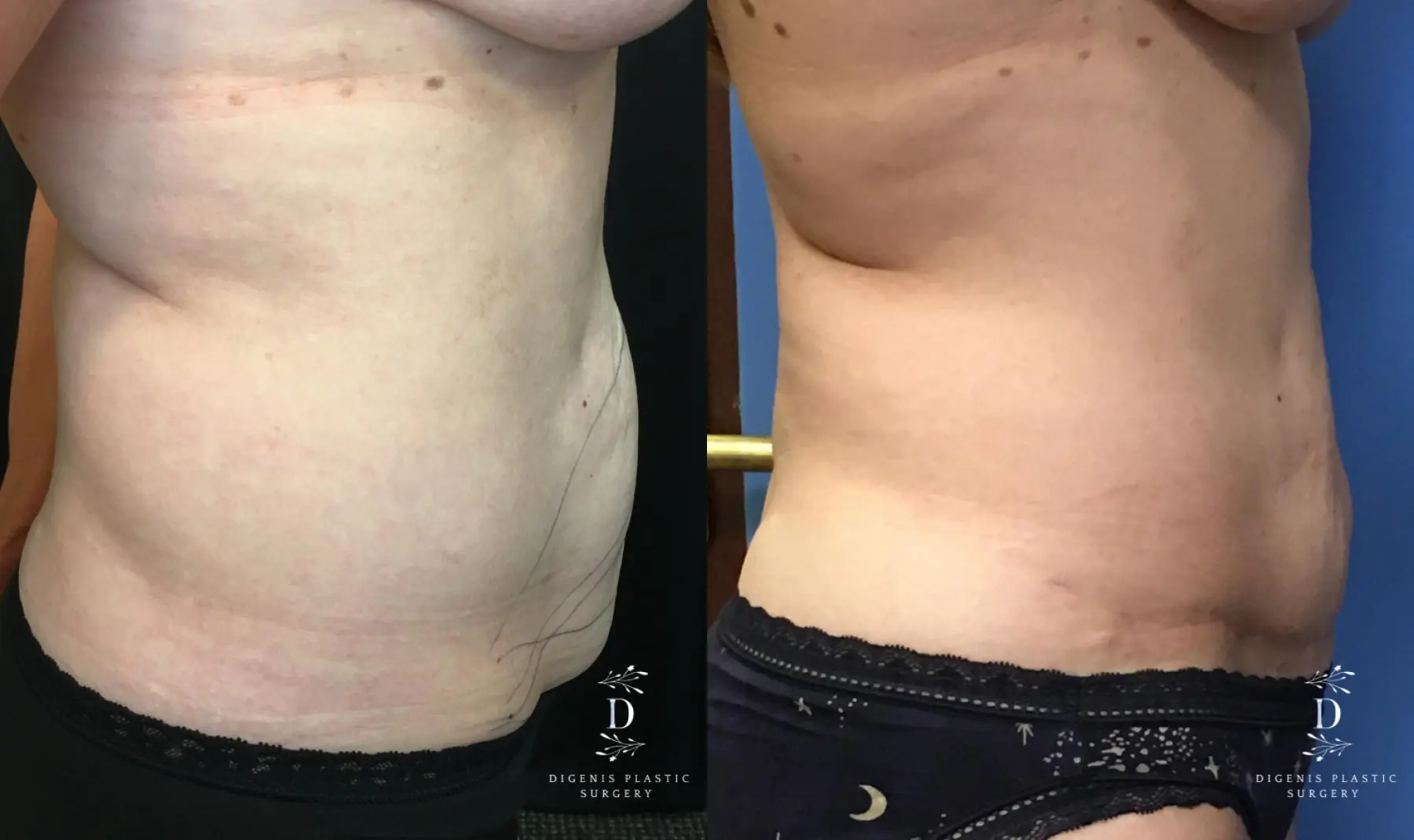 Tummy Tuck: Patient 20 - Before and After 3