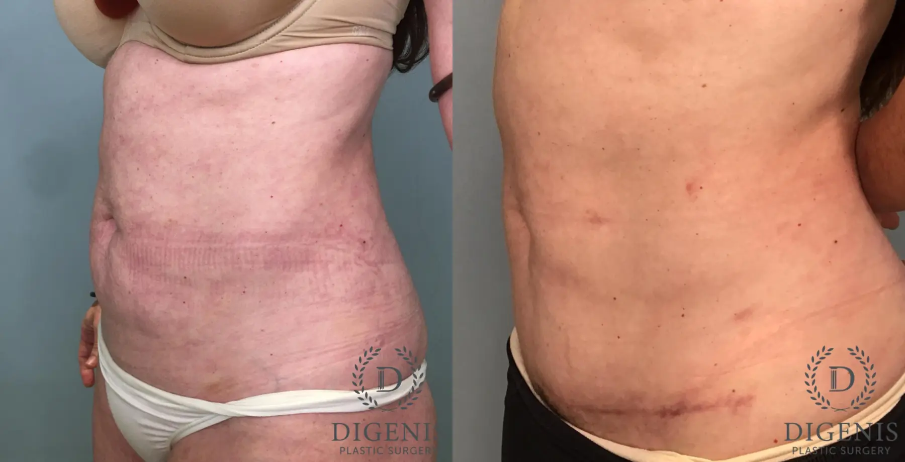 Tummy Tuck: Patient 6 - Before and After 2
